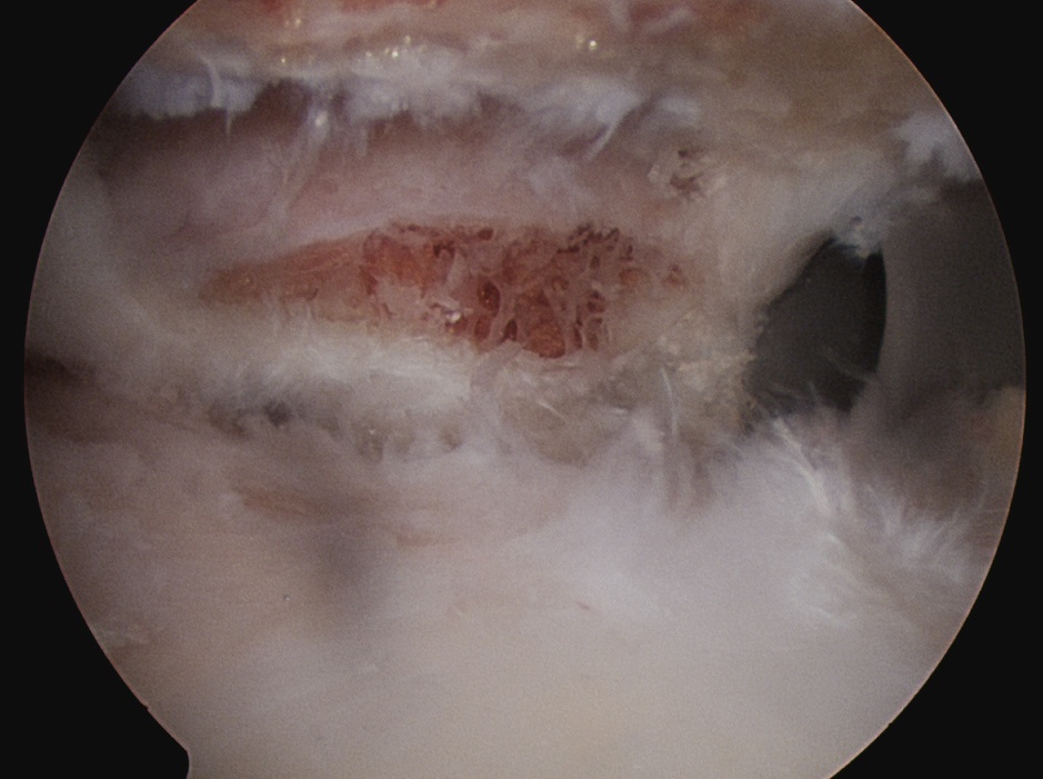 ACJ OA 3 Anterior Cannula